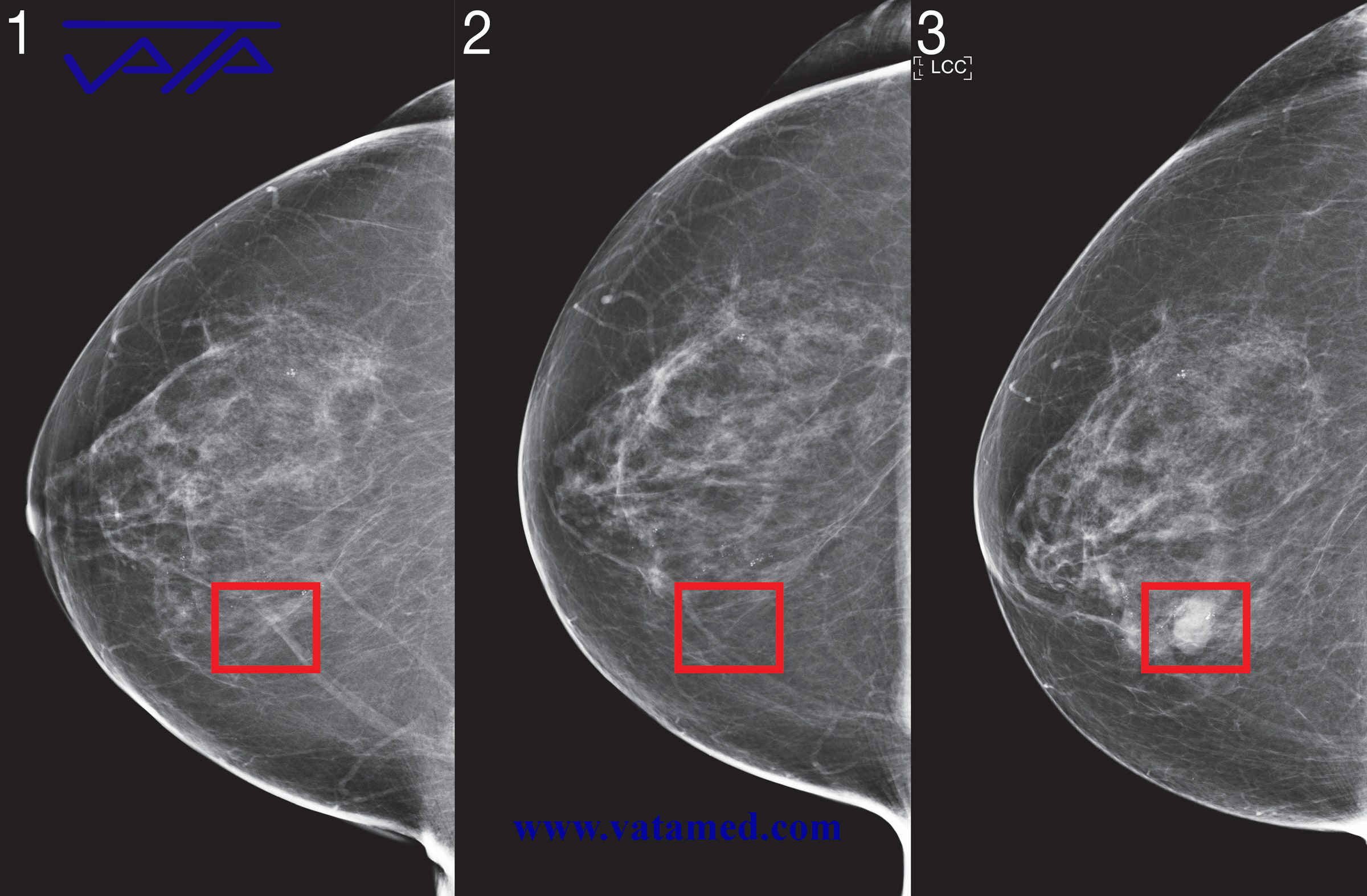 ماموگرافی پیشرفته