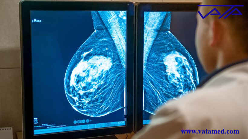 ماموگرافی پستان